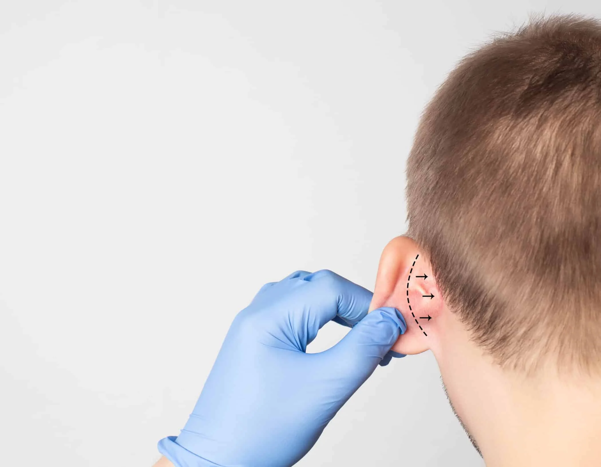 Everything-You-Need-to-Know-About-Otoplasty-Surgery-scaled-1.webp