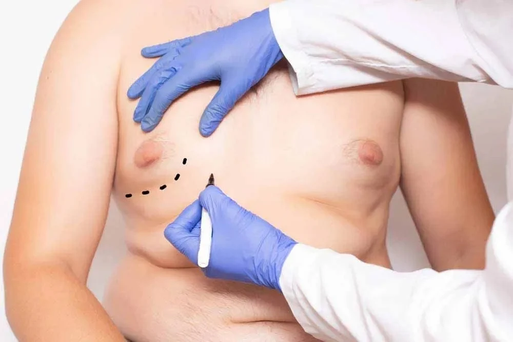 gynecomastia.webp