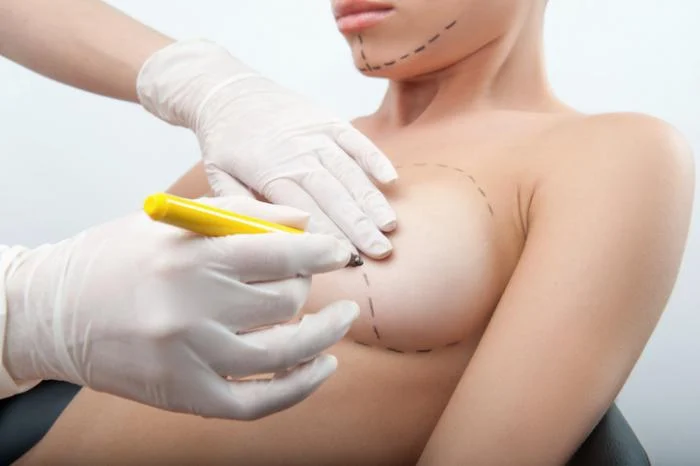 measuring-for-breast-surgery.webp