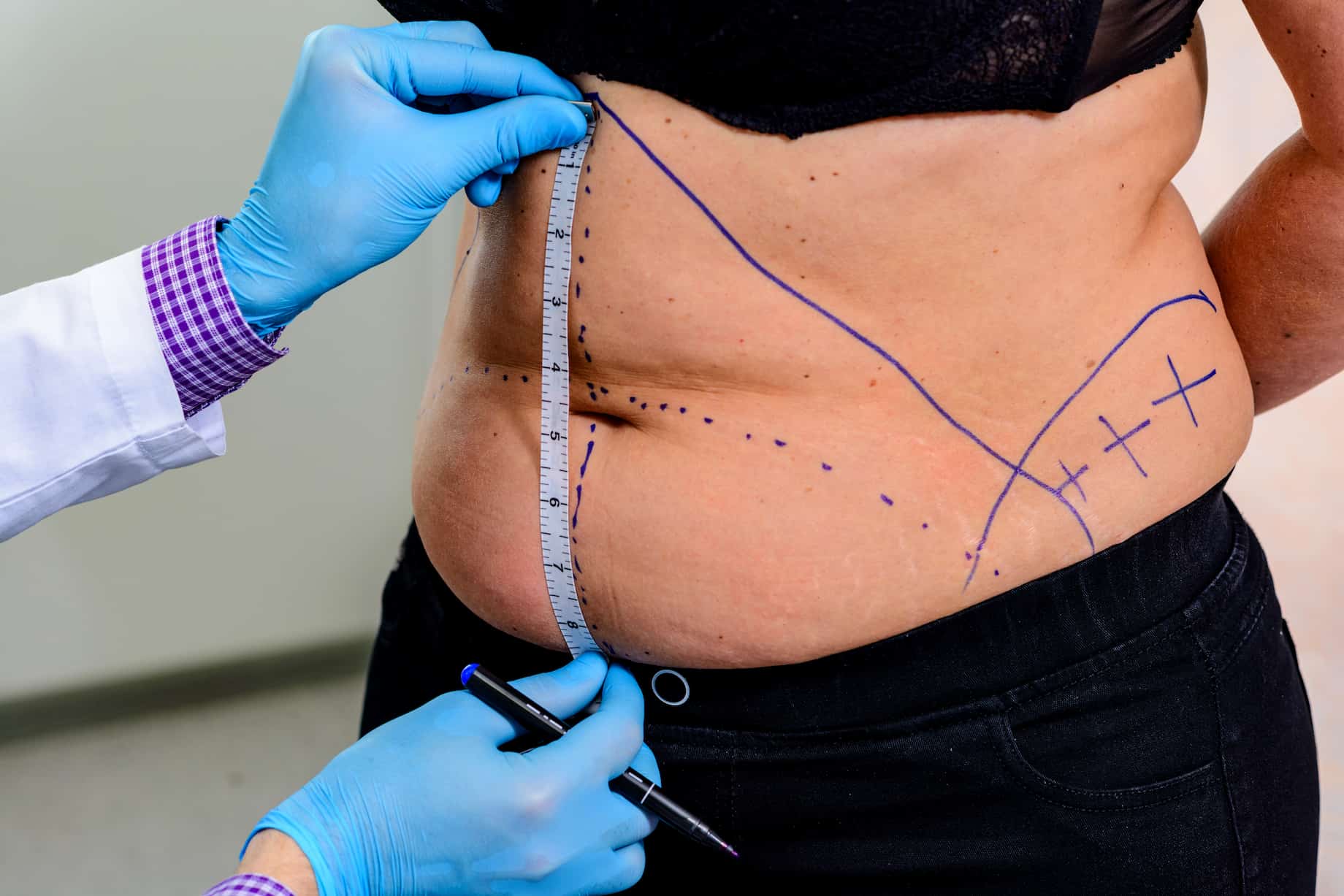 plus-size-tummy-tuck-procedure